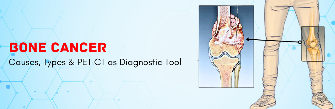 Bone Cancer: Causes, Types and PET CT as Diagnostic Tool